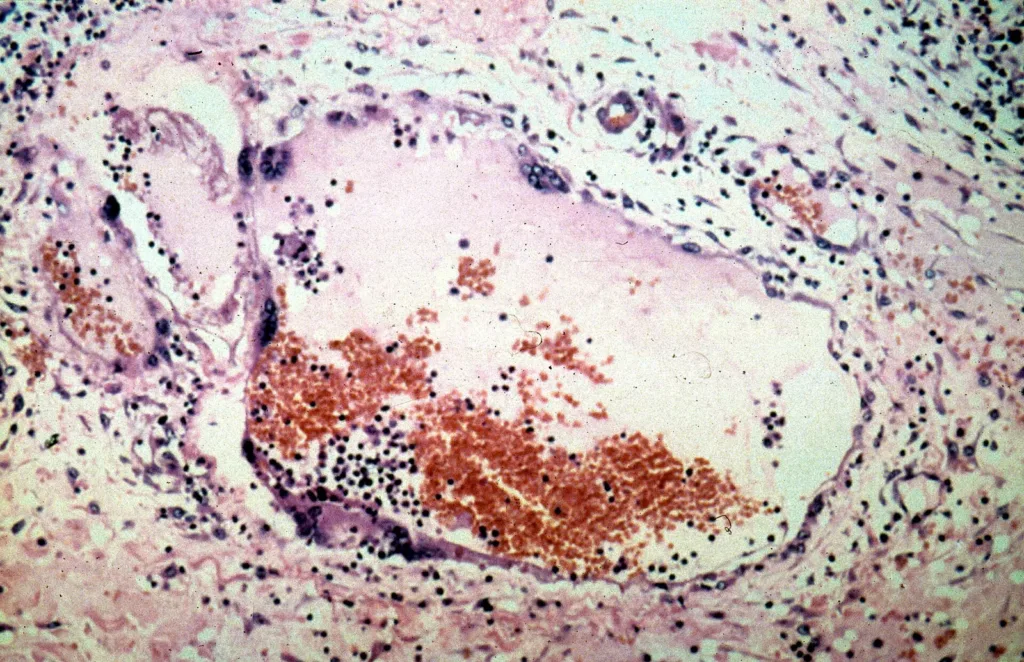 Microscope image of tissue infected by Nipah virus, CSIRO file image for Nipah remdesivir probe story
